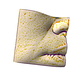 skin wrinkle  after(nasolabial fold)